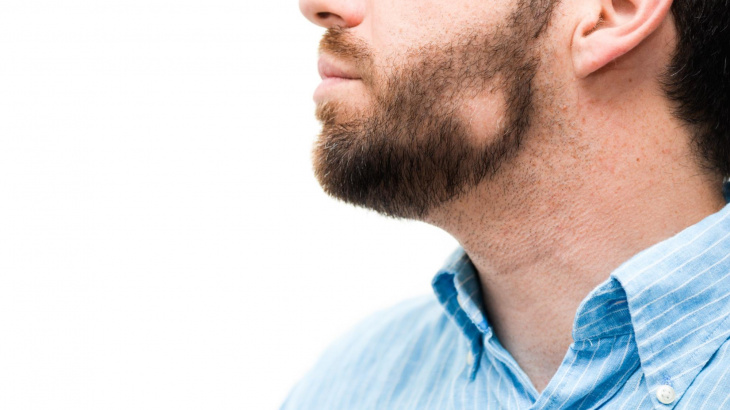 Alopecia na barba